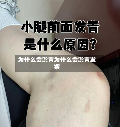 为什么会淤青为什么会淤青发紫